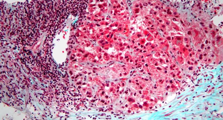 Microscope image of hepatocellular carcinoma, the most common form of cancer to arise in the liver. 